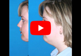 Neck Contouring Gallery Video 2