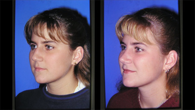 Nashville Nasal (Rhinoplasty) Plastic Surgery Before and After
