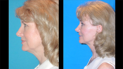 Facelift, Brow Lift, Eyelid Lift, Nasal Surgery Before and After