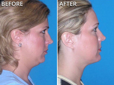 NECK CONTOURING GALLERY