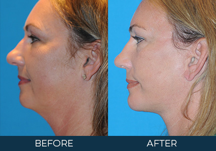 Before and After Chin Augmentation