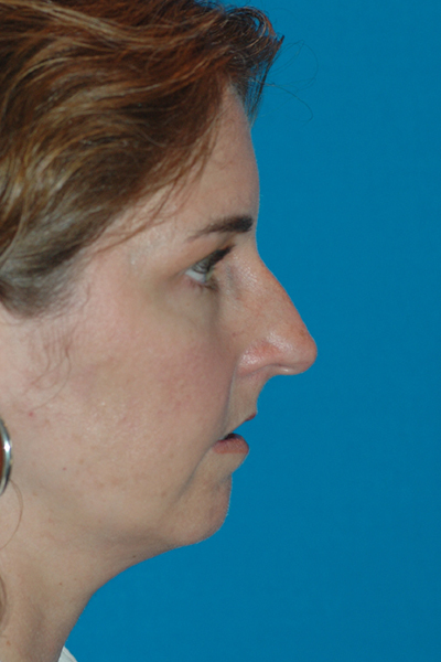 Rhinoplasty Before - Dr. Mark A. Clymer - Nashville, TN