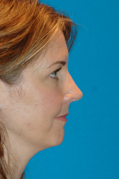 Rhinoplasty After - Dr. Mark A. Clymer - Nashville, TN
