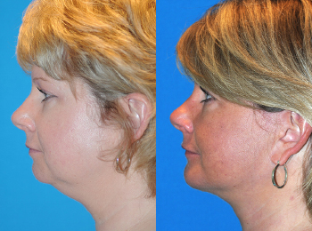 Chin Augmentation Before & After - Dr. Mark A. Clymer - Nashville, TN