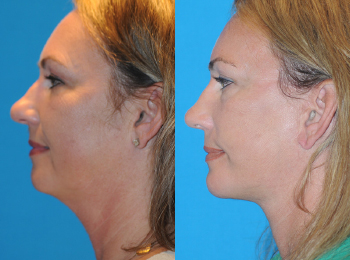 Chin Augmentation Before & After - Dr. Mark A. Clymer - Nashville, TN
