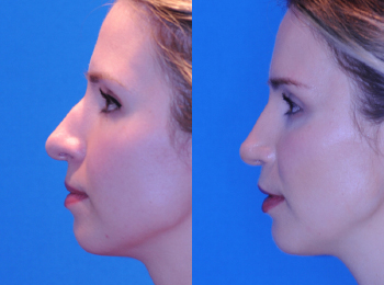Chin Augmentation Before & After - Dr. Mark A. Clymer - Nashville, TN