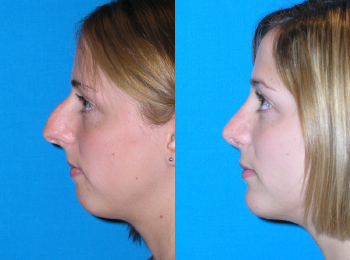 Chin Augmentation Before & After - Dr. Mark A. Clymer - Nashville, TN