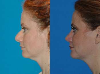 Chin Augmentation Before & After - Dr. Mark A. Clymer - Nashville, TN