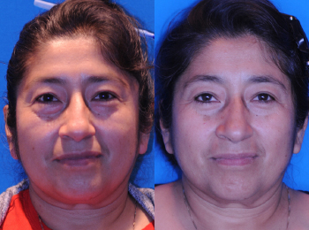 Eyelid Lift Before & After - Dr. Mark A. Clymer - Nashville, TN