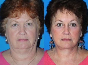 Facelift Before & After - Dr. Mark A. Clymer - Nashville, TN