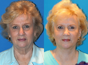 Facelift Before & After - Dr. Mark A. Clymer - Nashville, TN
