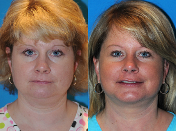 Facelift Before & After - Dr. Mark A. Clymer - Nashville, TN