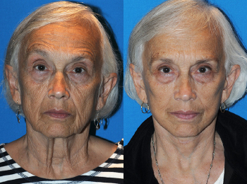 Facelift Before & After - Dr. Mark A. Clymer - Nashville, TN