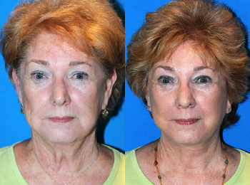 Facelift Before & After - Dr. Mark A. Clymer - Nashville, TN