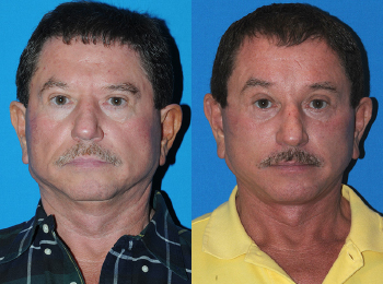 Facelift Before & After - Dr. Mark A. Clymer - Nashville, TN