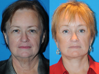 Facelift Before & After - Dr. Mark A. Clymer - Nashville, TN