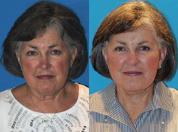 Facelift Before & After - Dr. Mark A. Clymer - Nashville, TN