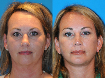 Facelift Before & After - Dr. Mark A. Clymer - Nashville, TN