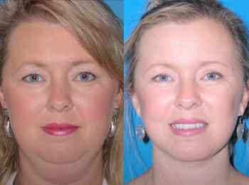 Facelift Before & After - Dr. Mark A. Clymer - Nashville, TN