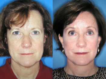 Facelift Before & After - Dr. Mark A. Clymer - Nashville, TN