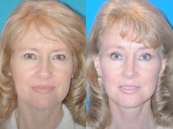 Facelift Before & After - Dr. Mark A. Clymer - Nashville, TN