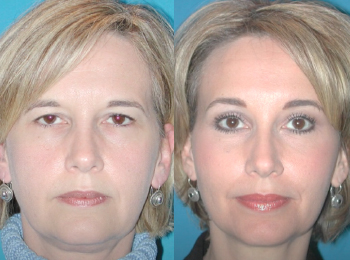 Facelift Before & After - Dr. Mark A. Clymer - Nashville, TN