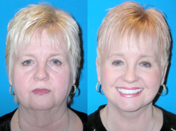 Facelift Before & After - Dr. Mark A. Clymer - Nashville, TN