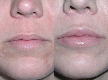 Lip Lift Before & After - Dr. Mark A. Clymer - Nashville, TN