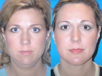 Neck Contouring Before & After - Dr. Mark A. Clymer - Nashville, TN