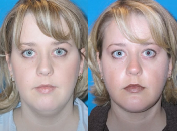 Neck Contouring Before & After - Dr. Mark A. Clymer - Nashville, TN