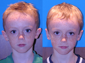 Otoplasty Before & After - Dr. Mark A. Clymer - Nashville, TN