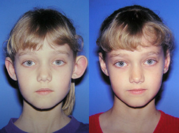 Otoplasty Before & After - Dr. Mark A. Clymer - Nashville, TN