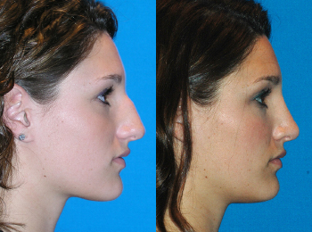 Rhinoplasty Before & After - Dr. Mark A. Clymer - Nashville, TN