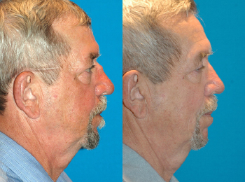 Rhinoplasty Before & After - Dr. Mark A. Clymer - Nashville, TN