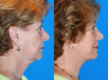 Rhinoplasty Before & After - Dr. Mark A. Clymer - Nashville, TN