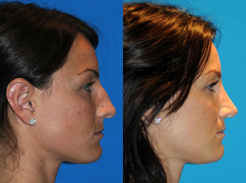 Rhinoplasty Before & After - Dr. Mark A. Clymer - Nashville, TN