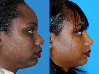 Rhinoplasty Before & After - Dr. Mark A. Clymer - Nashville, TN