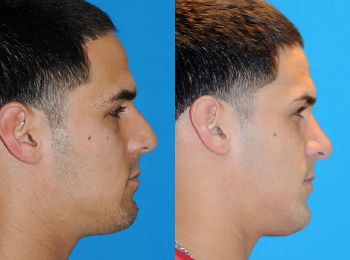 Rhinoplasty Before & After - Dr. Mark A. Clymer - Nashville, TN