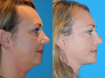 Rhinoplasty Before & After - Dr. Mark A. Clymer - Nashville, TN