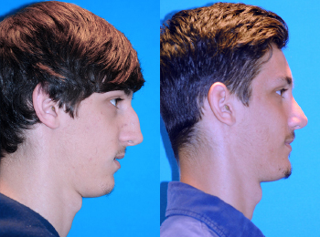 Rhinoplasty Before & After - Dr. Mark A. Clymer - Nashville, TN