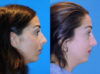 Rhinoplasty Before & After - Dr. Mark A. Clymer - Nashville, TN