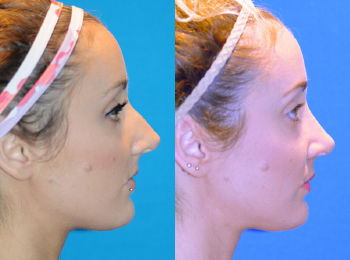 Rhinoplasty Before & After - Dr. Mark A. Clymer - Nashville, TN