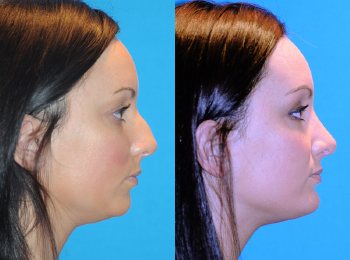 Rhinoplasty Before & After - Dr. Mark A. Clymer - Nashville, TN