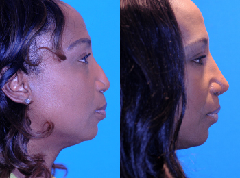 Rhinoplasty Before & After - Dr. Mark A. Clymer - Nashville, TN