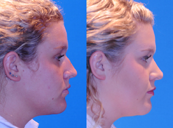 Rhinoplasty Before & After - Dr. Mark A. Clymer - Nashville, TN