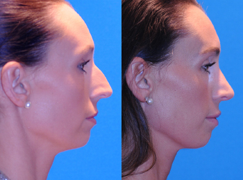 Rhinoplasty Before & After - Dr. Mark A. Clymer - Nashville, TN