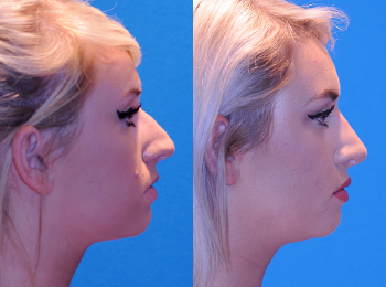 Rhinoplasty Before & After - Dr. Mark A. Clymer - Nashville, TN