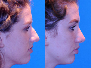 Rhinoplasty Before & After - Dr. Mark A. Clymer - Nashville, TN