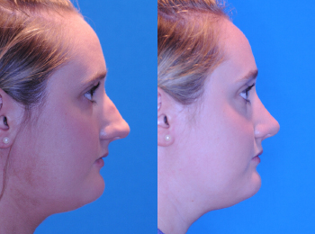 Rhinoplasty Before & After - Dr. Mark A. Clymer - Nashville, TN