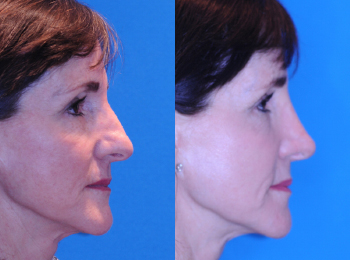 Rhinoplasty Before & After - Dr. Mark A. Clymer - Nashville, TN